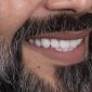 نمونه لمینت دندان سال 99