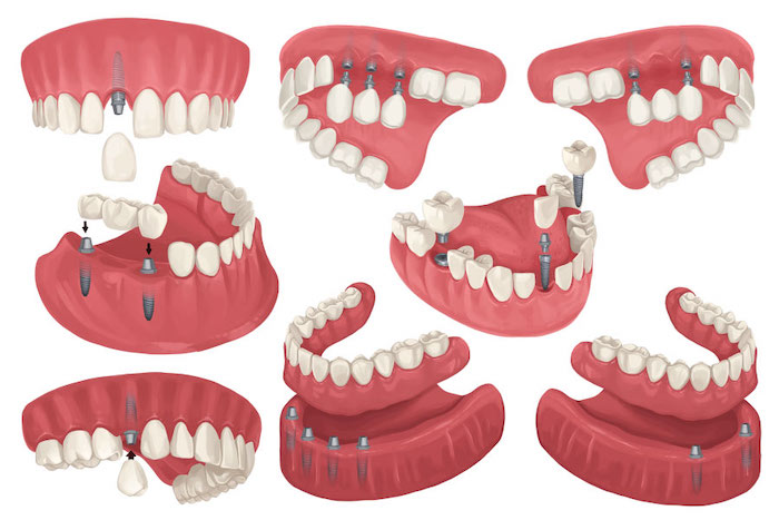 انواع روش کاشت دندان
