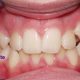کراس بایت دندان چیست