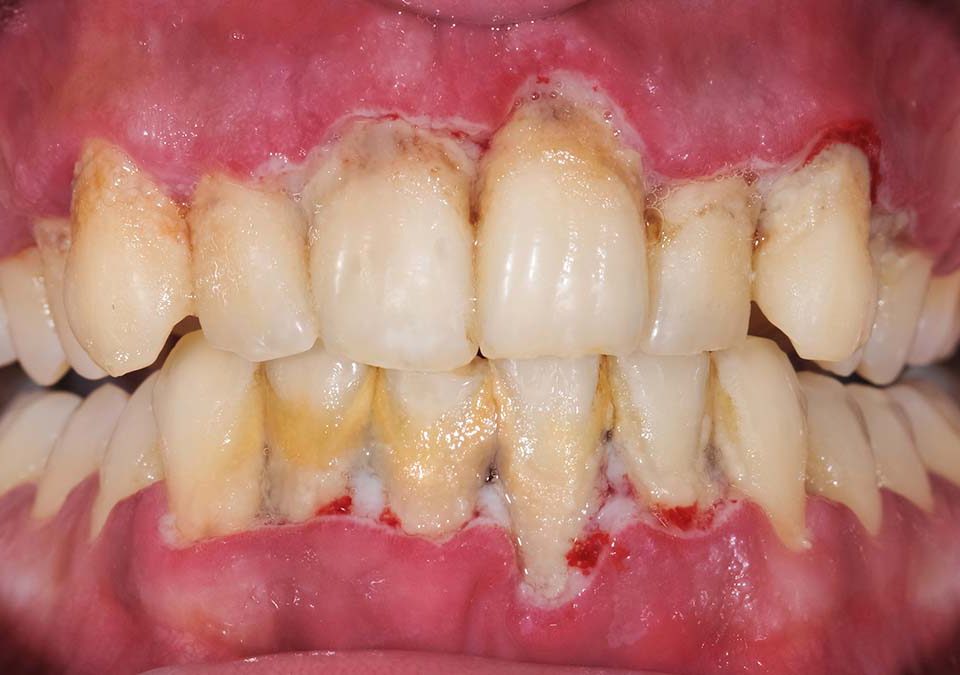 بیماری پریودنتال دندان