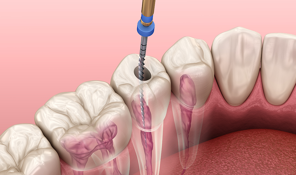 کانال ریشه دندان