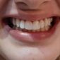 کامپوزیت لامینت ونیر دندان