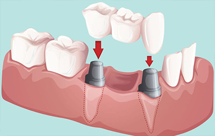 بریج دندان چیست و کاربرد انواع دندان بریج کدام است؟