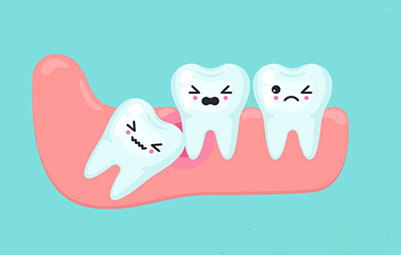 دندان عقل چیست مزایای کشیدن دندان عقل را بدانید